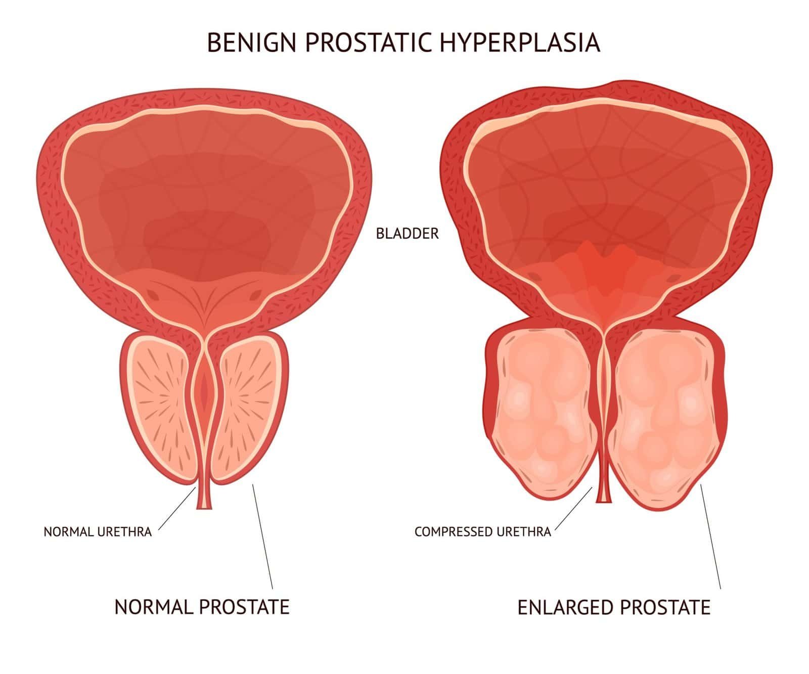 Enlarged prostate illustration for prostate health and BPH symptoms at London Prostate Clinic.