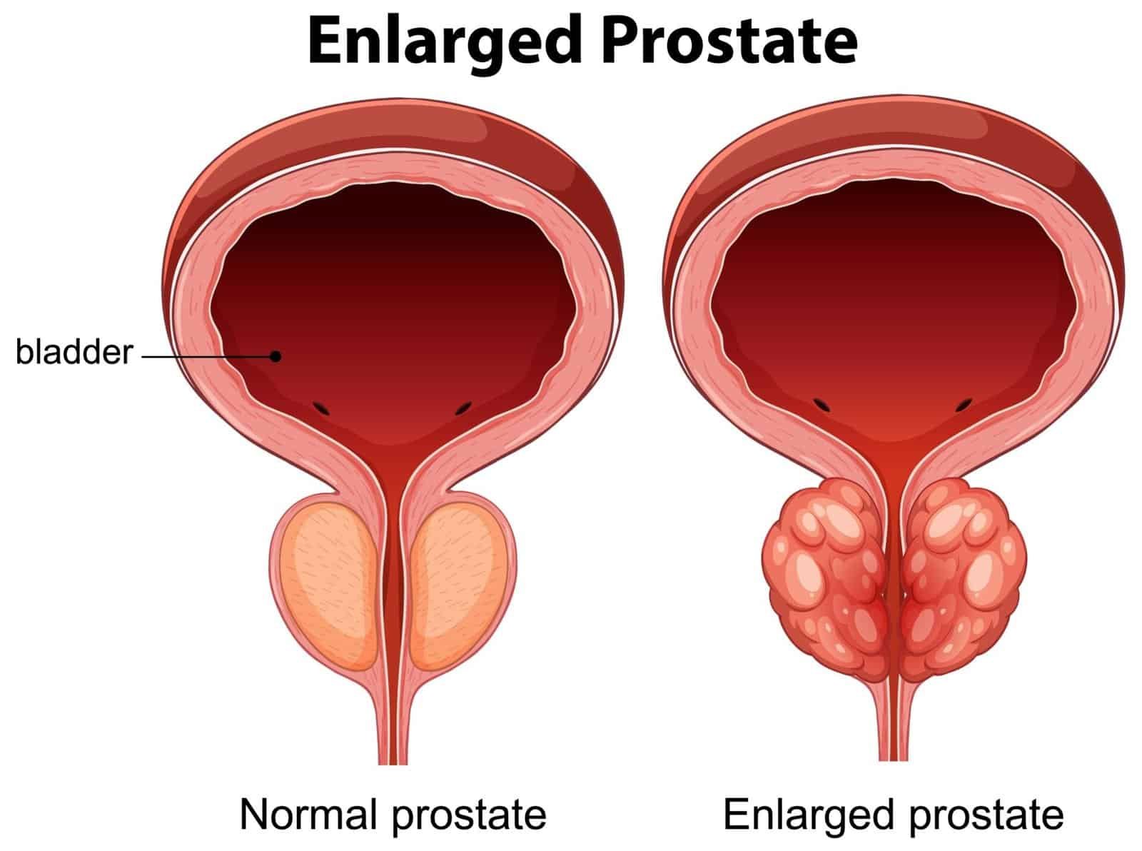 normal prostate size
