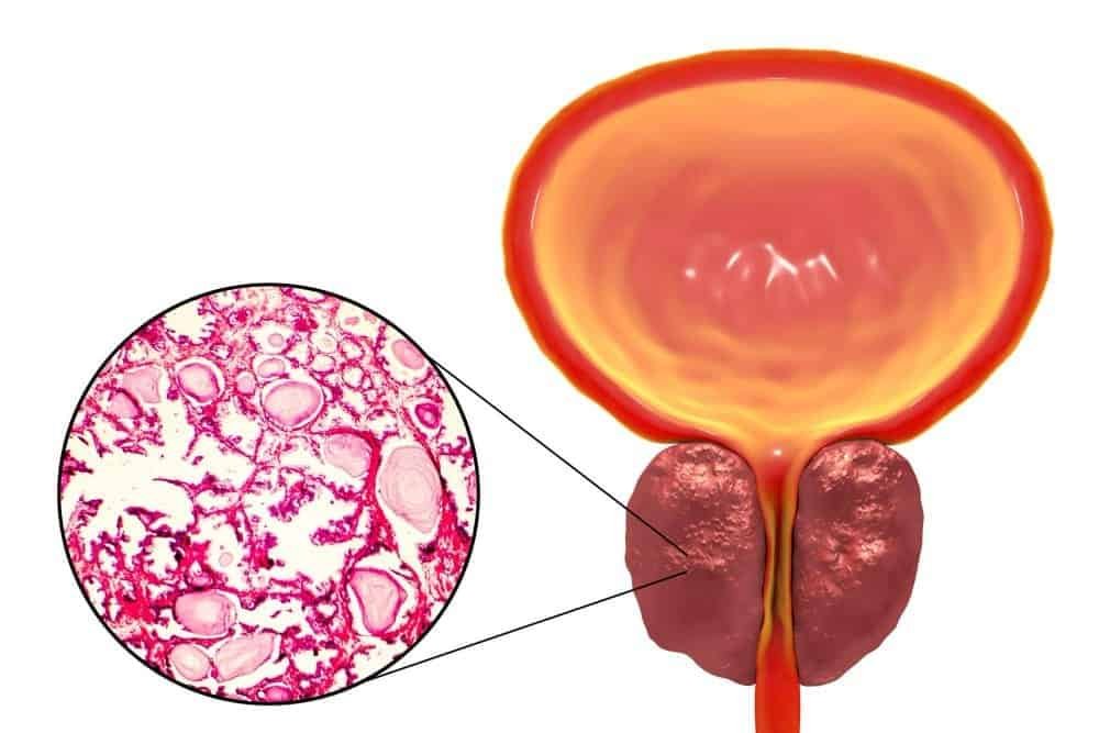 How Long Does Prostate Artery Embolization Last?
