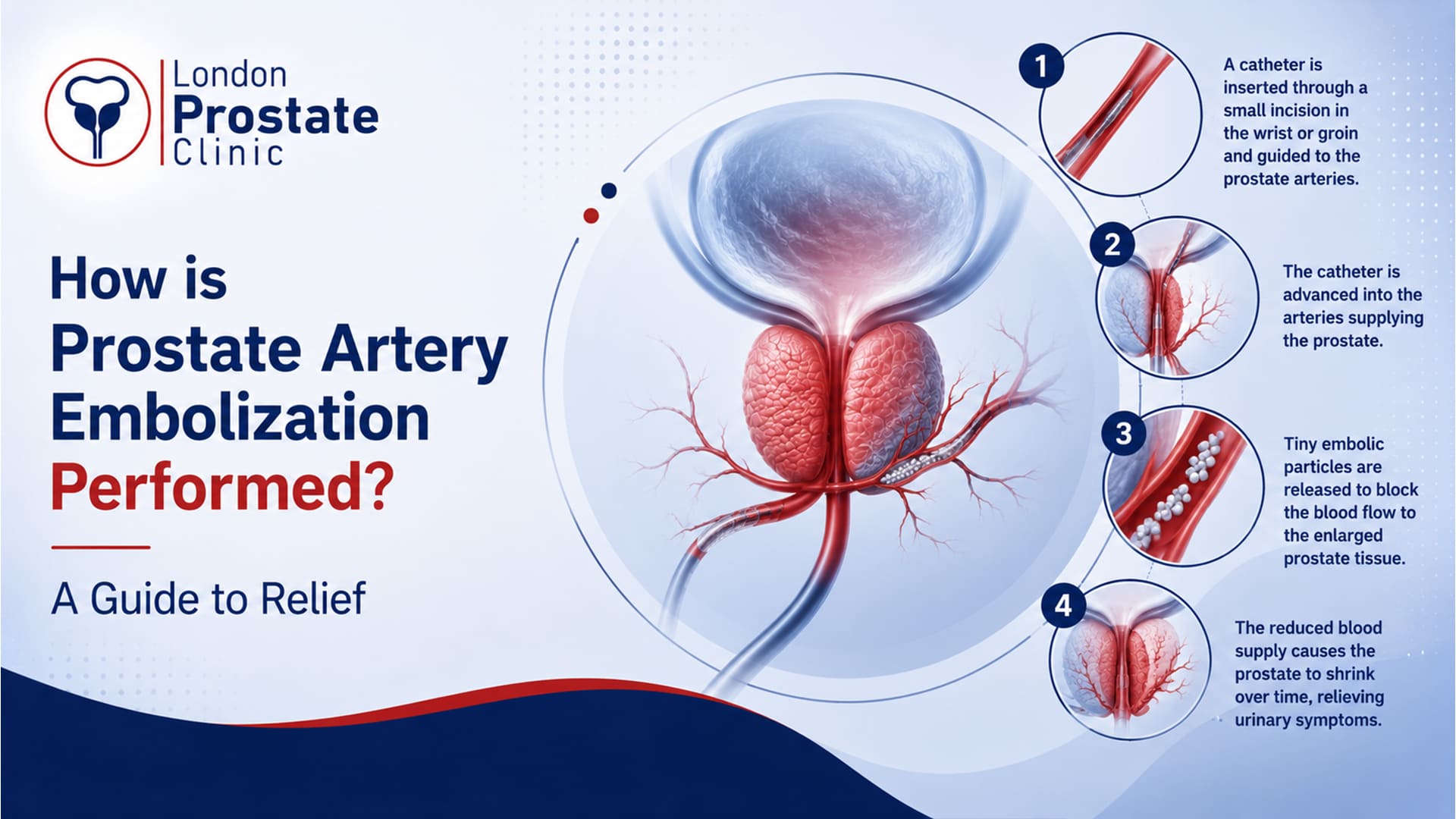 How is Prostate Artery Embolization Performed? A Guide to Relief